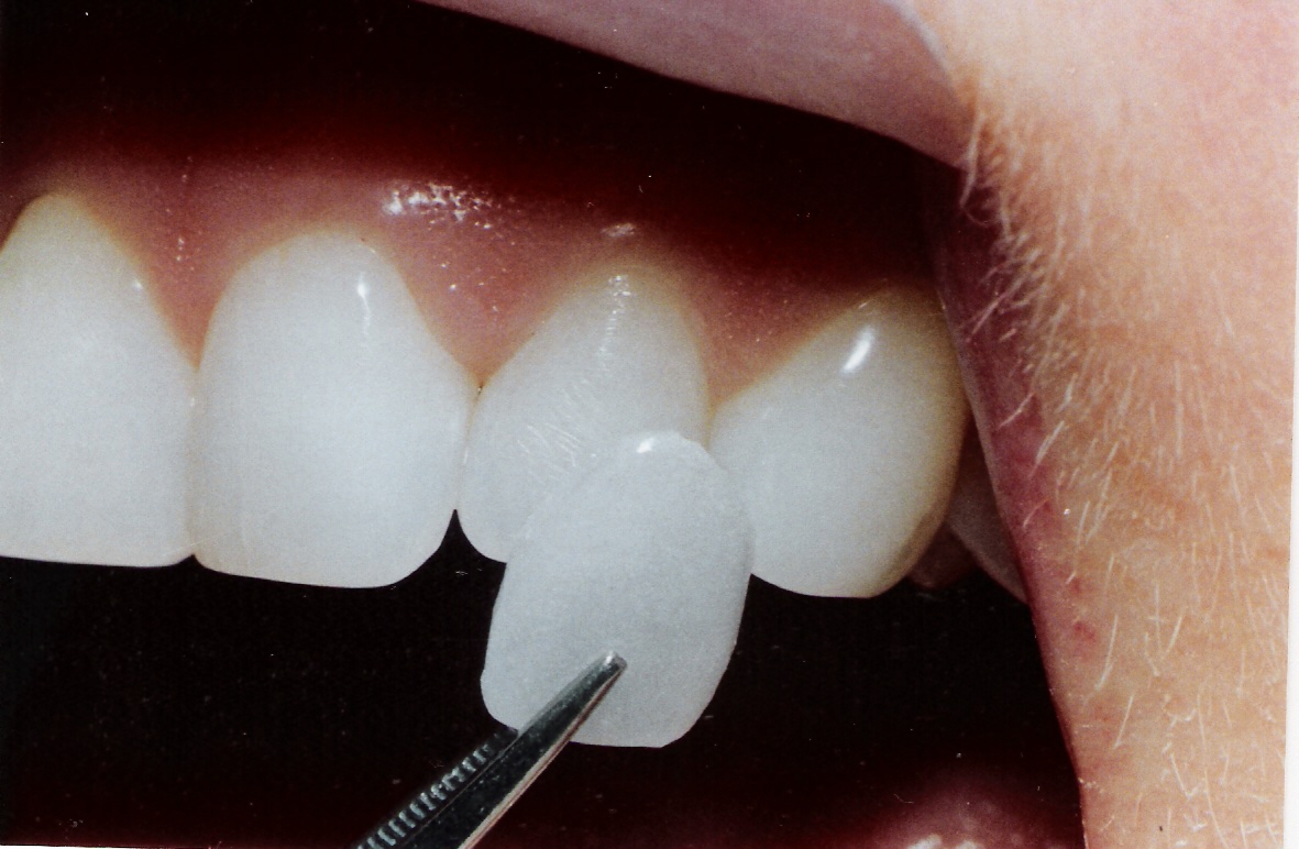 Bọc răng sứ Veneer 1