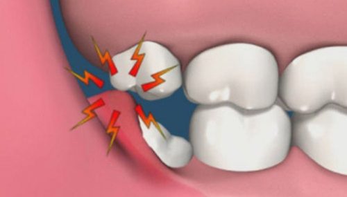 Mọc răng khôn uống thuốc gì để giảm tình trạng đau nhức? 1