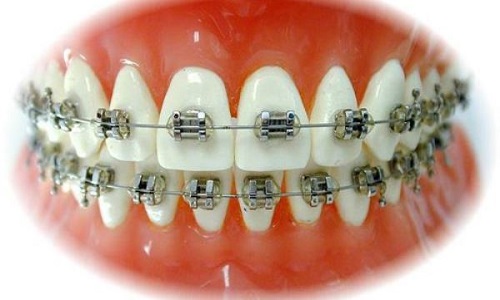 Niềng răng mắc cài kim loại - Đánh giá ưu và nhược điểm 1
