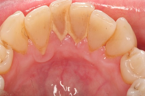 Lấy cao răng có ảnh hưởng không? Lưu ý sau khi lấy cao răng 1
