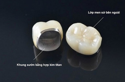Có nên trồng răng sứ kim loại không? Bác sĩ tư vấn 1